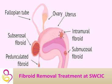 Fibroids Treatment in Hyderabad