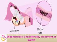 Endometriosis And Infertility Treatment