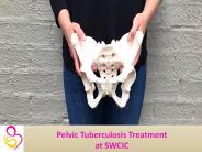 Pelvic Tuberculosis Treatment