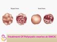 Polycystic Ovaries Treatment PowerPoint PPT Presentation