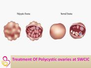 Polycystic Ovaries Treatment