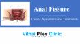 Anal Fissure​: Causes, Symptoms and Treatments​ PowerPoint PPT Presentation