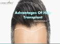 Advantages Of Hair Transplant. PowerPoint PPT Presentation