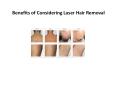 Benefits of Considering Laser Hair Removal PowerPoint PPT Presentation