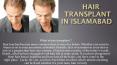 Hair transplant in Islamabad (2) PowerPoint PPT Presentation