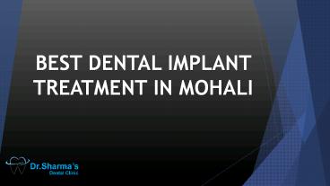 Best Dental Implant Treatment in Mohali