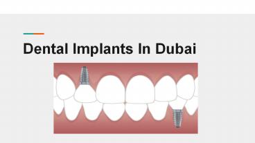 Dental Implants in Dubai