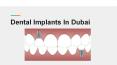 Dental Implants in Dubai PowerPoint PPT Presentation