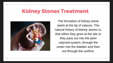 Best Kidney Stones Treatment