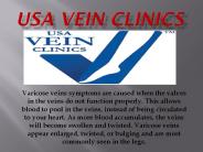 varicose vein treatments