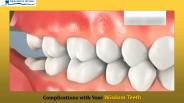 Complications with Your Wisdom Teeth