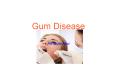 Gum disease - an overview PowerPoint PPT Presentation