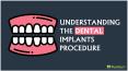 Understanding the dental implants procedure PowerPoint PPT Presentation