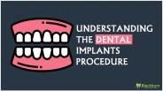 Understanding the dental implants procedure