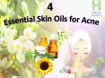 What is the use of 4 various essential oils for Acne? PowerPoint PPT Presentation