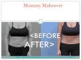 Mommy Makeover in Kansas PowerPoint PPT Presentation