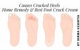 What Causes Cracked Heels - Home Remedy & Best Foot Crack Cream for That PowerPoint PPT Presentation