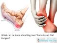 What can be done about Ingrown Toenails and Nail Fungus? PowerPoint PPT Presentation