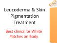 Skin Pigmentation Treatments in Delhi PowerPoint PPT Presentation