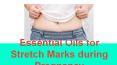 Natural Essential Oils for stretch marks during pregnancy PowerPoint PPT Presentation
