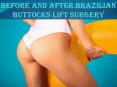 Brazilian Butt Lift Before & After Pictures Atlanta, Buckhead, ATL PowerPoint PPT Presentation