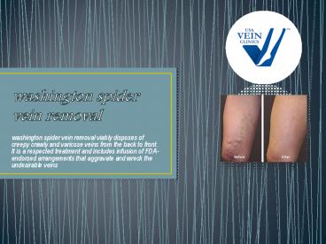 washington spider vein removal