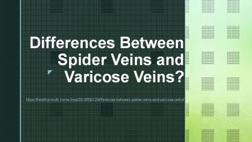 Differences Between Spider Veins and Varicose Veins?