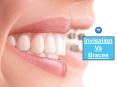 Invisalign Vs Braces | Orthodontic Experts of Colorado PowerPoint PPT Presentation