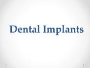 Dental Implants