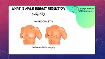 Male breast reduction in chicago