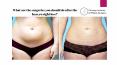 After heavy weight loss, how to remove the excess skin? PowerPoint PPT Presentation