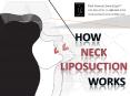 How Neck Liposuction Works PowerPoint PPT Presentation