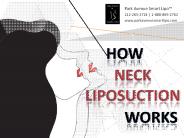 How Neck Liposuction Works