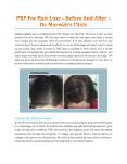 PRP For Hair Loss — Before And After — Dr. Marwah’s Clinic PowerPoint PPT Presentation