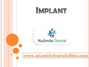 Implant - nusmiledentaloffice.com