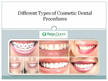Cosmetic Dental Treatment
