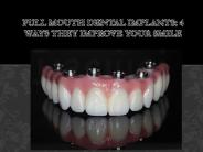 Full Mouth Implant Treatment