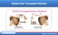 Global Hair Transplant Market is US$ 30 Billion by 2025 - Renub Research PowerPoint PPT Presentation