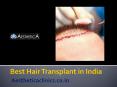 Best Hair Transplant in India PowerPoint PPT Presentation