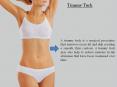 Tummy Tuck PowerPoint PPT Presentation