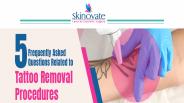 5 FREQUENTLY ASKED QUESTIONS RELATED TO TATTOO REMOVAL PROCEDURES
