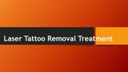 Lser Tattoo Removal