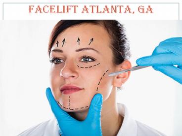 Facelift Atlanta, GA | Buckhead Face Lift