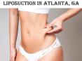LIPOSUCTION IN ATLANTA, GA PowerPoint PPT Presentation