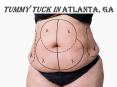 Tummy Tuck Atlanta, GA | Buckhead Tummy Tuck (Abdominoplasty) PowerPoint PPT Presentation