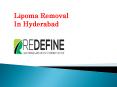 Lipoma Removal Cost In Hyderabad | Lipoma Removal In Hyderabad PowerPoint PPT Presentation