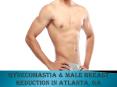 Gynecomastia Atlanta, GA | Buckhead Gynecomastia Surgery PowerPoint PPT Presentation