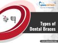 Types of Dental Braces PowerPoint PPT Presentation