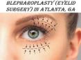 Blepharoplasty Atlanta, GA | Buckhead Blepharoplasty (Eyelid Surgery) PowerPoint PPT Presentation