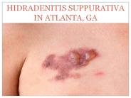 HIDRADENITIS SUPPURATIVA IN ATLANTA, GA